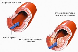 Артериосклероз