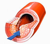 Артеросклероз